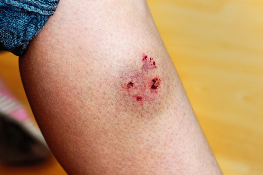 Steps to Take After a Dog Bite Injury in Virginia